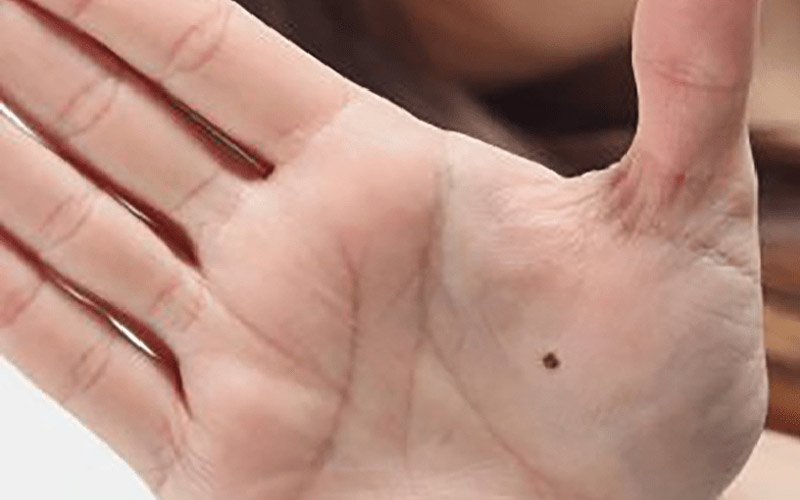 Mole in your palm