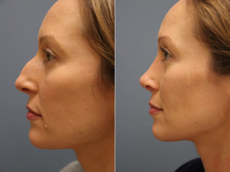 Rhinoplasty