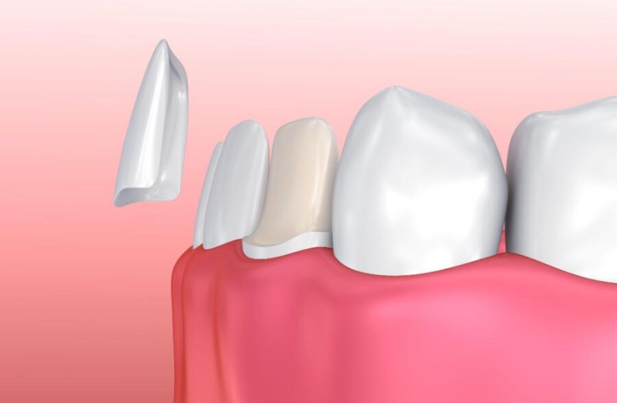 What are Dental Veneers