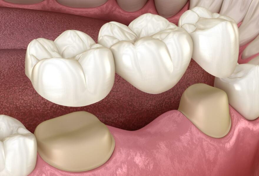 Benefits of A Dental Bridge