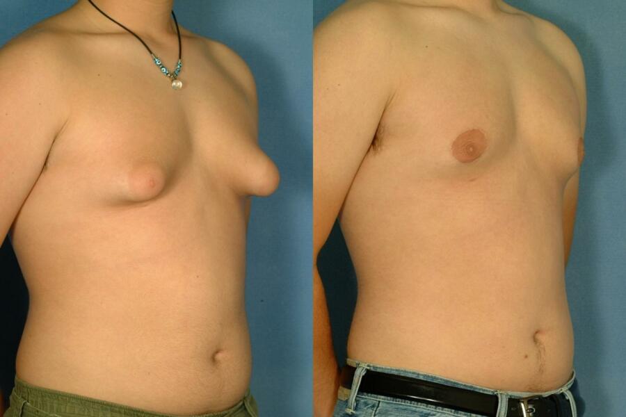 Gynecomastia treatment