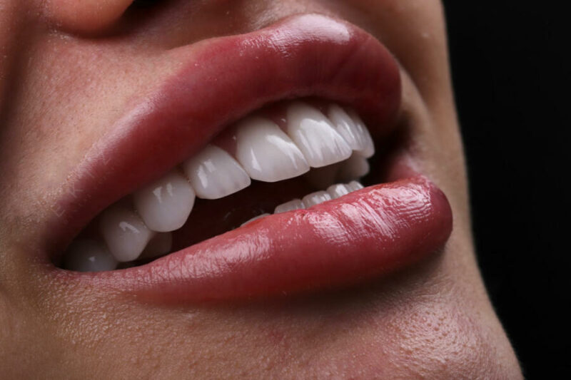 A Complete Guide about Emax Laminate Veneers Turkey