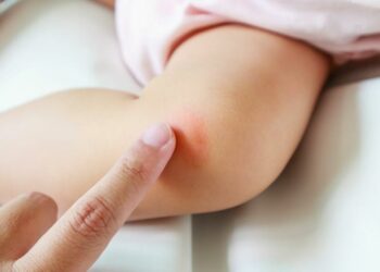 Common Skin Rash Problems in Babies and How a Pediatrician Helps?