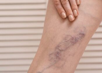 Deep Vein Thrombosis (DVT): Symptoms, Causes, & Treatment