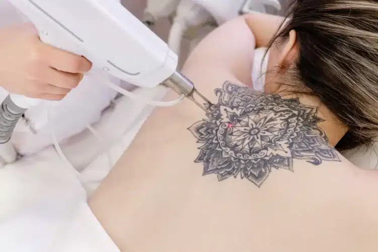 Tattoo Removal
